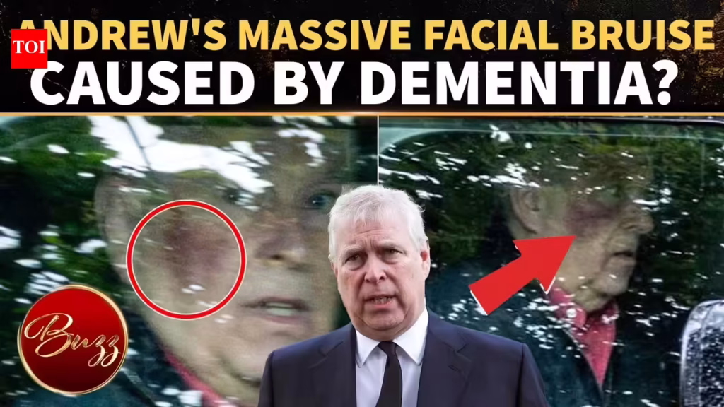 Andrew Windsor’s Facial Injury Sparks Dementia Speculation After Insiders Sound Alarm