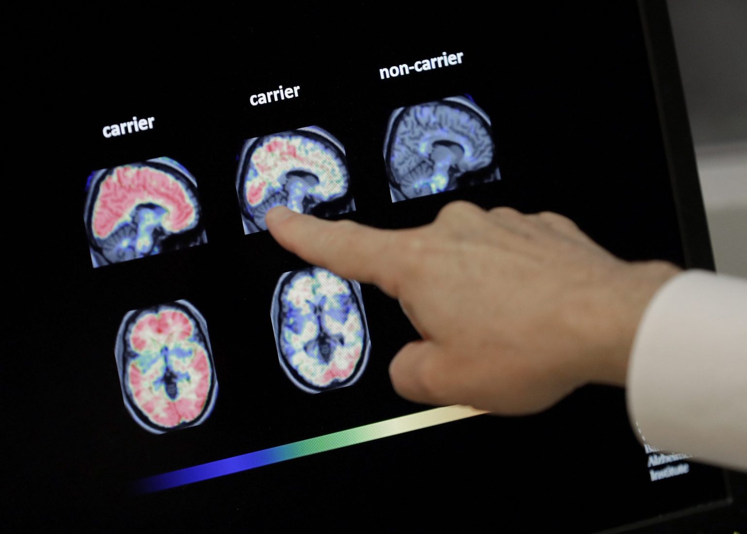 9 in 10 adults with Down syndrome develop Alzheimer’s. UNT Health research is exploring why