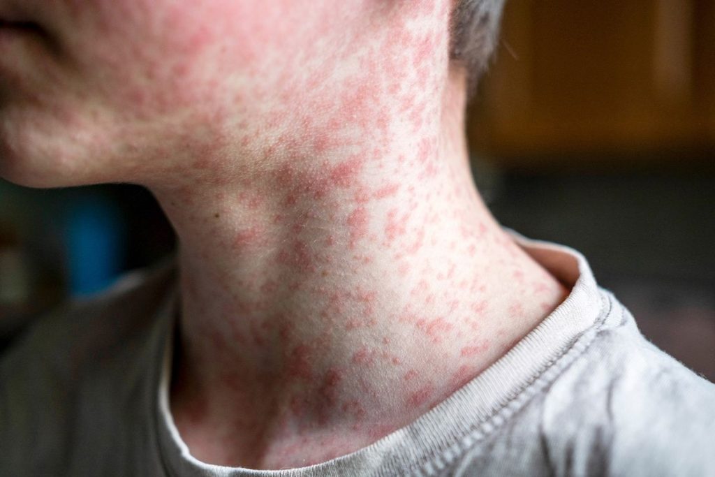 Health officials report another measles exposure in Northern…